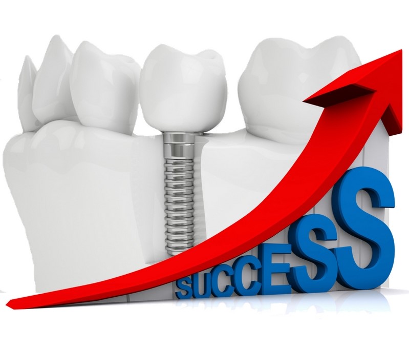 Highest Dental Implants Success Rate