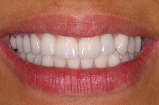 Teeth Whitening in Orange County, CA