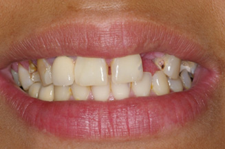 need full mouth reconstruction with 9 implants and individual crowns on teeth and implants