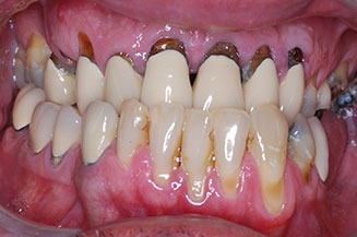 need full mouth reconstruction with multiple implants and individual crowns on teeth & implants