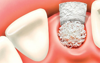 The Alveolar Ridge Preservation Graft or “Socket Graft