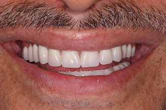 full mouth reconstruction with 2 full arch bridges and 12 implants