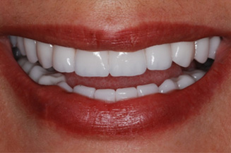full mouth reconstruction with multiple implants and individual crowns on teeth & implants