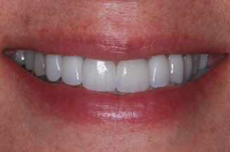 smile makeover with 2 implants and 6 crowns on teeth and implants, in a single visit