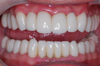 full mouth reconstruction with multiple implants & individual crowns on teeth and implants