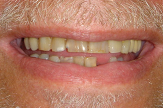 need full mouth reconstruction with 2 full arch bridges and 12 implants