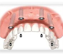 All On 4 Dental Implants in Orange County, CA