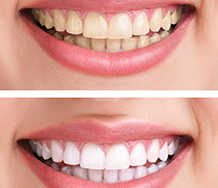 Teeth Whitening in Orange County, CA