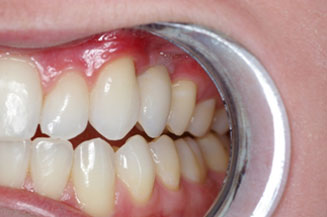Single Tooth Implants in Orange County, CA
