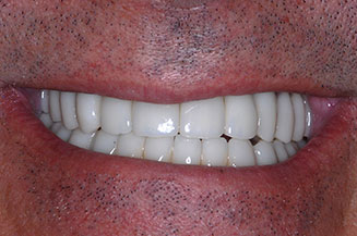 full mouth reconstruction with multiple implants and individual crowns on teeth & implants