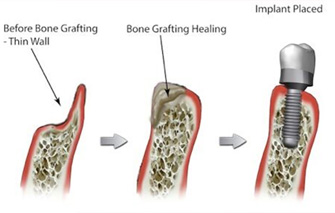 dental bone grafting