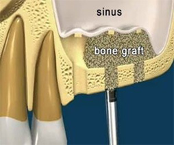 sinus lift procedure