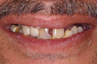 dental gaps