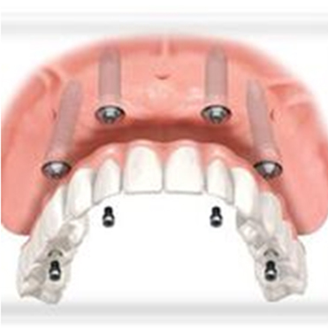 All on 4 Dental Implants