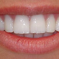 Teeth Whitening in Orange County, CA