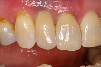 single implant and crown