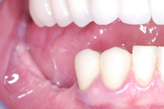 dental implants and crown