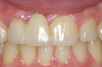 need 1 implant and crown, and 3 veneers