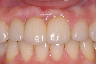 need 1 implant and crown, and 3 veneers