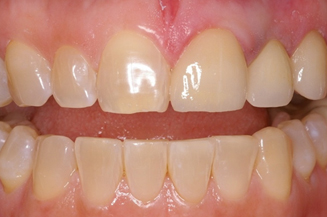 smile makeover with 1 implant and crown, and 3 veneers