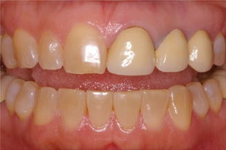 replacing old 3 unit bridge with 1 implant and 3 individual crowns