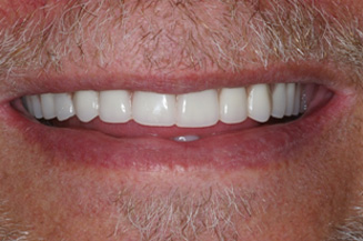 full mouth reconstruction with 2 full arch bridges and 12 implants