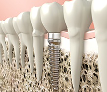 dental implants