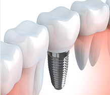 Single Tooth Implants