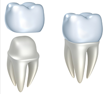 Bone Grafting in Orange County, CA