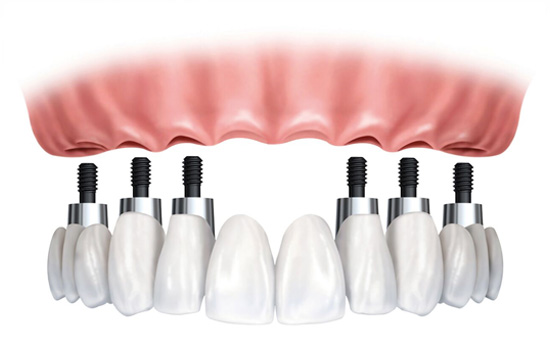 full arch implant bridge