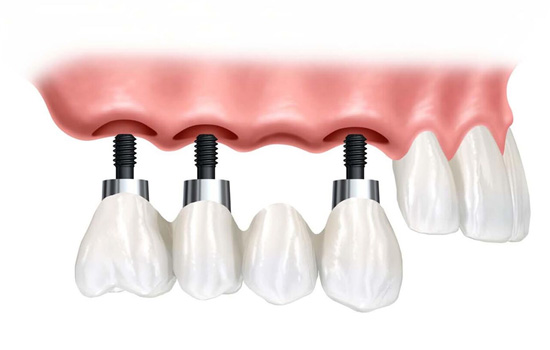 Unilateral Fixed Bridge on Implants